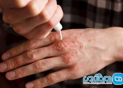 چرا پسوریازیس با بیماری های مفصلی مرتبط است؟