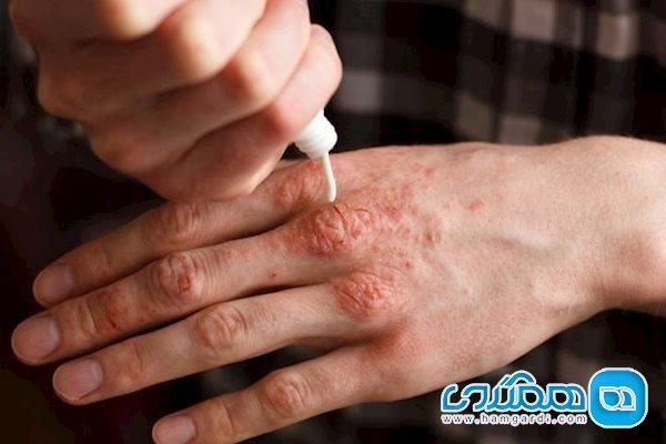چرا پسوریازیس با بیماری های مفصلی مرتبط است؟ چرا پسوریازیس با بیماری های مفصلی مرتبط است؟