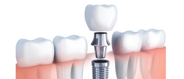 جراحی ایمپلنت دندان و نکاتی که باید راجع به آن بدانید