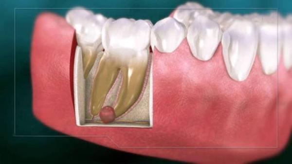 دلیل کیست دندان چیست؟ و راه درمان آن چه می باشد؟